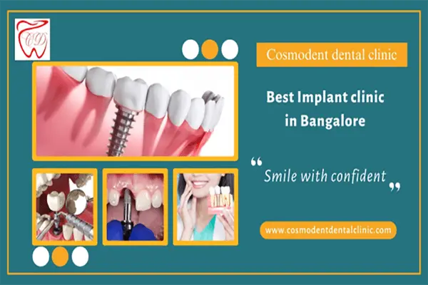 Best Dental Implant Clinic in Bangalore