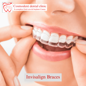 Invisalign braces