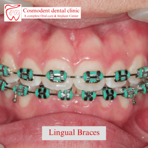 Lingual braces