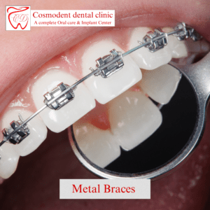 Metal braces