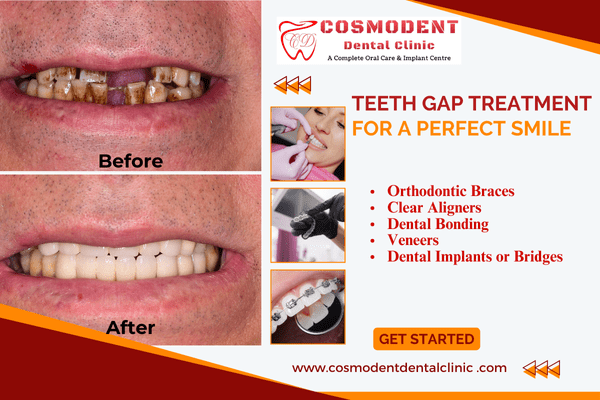 Expert Teeth Gap Treatment for a Perfect Smile