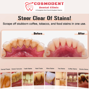 Plaque on Teeth