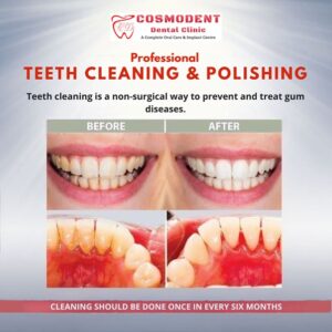 Teeth cleaning & polishing  Before & after image