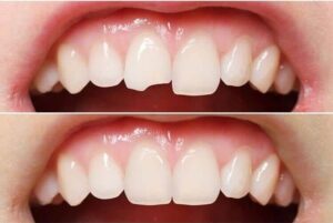 Cosmetic dental bonding in chipped tooth